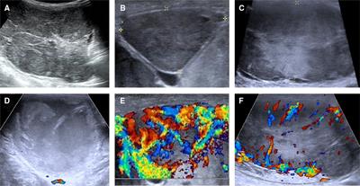 Case report: Large follicular thyroid carcinoma with multiple cervical lymph node metastases